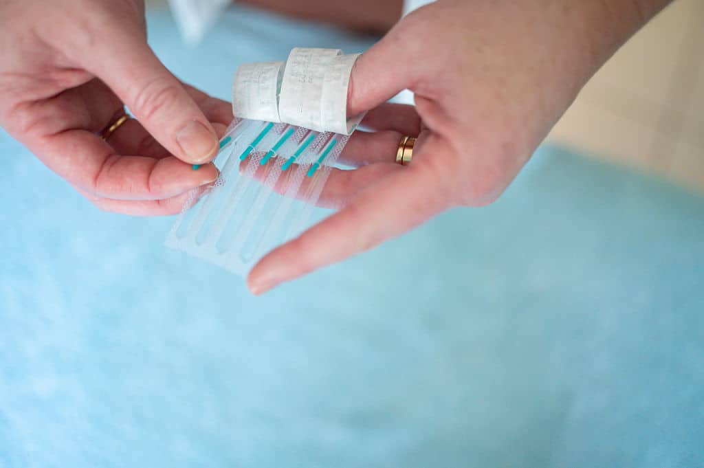 Acupuncture
