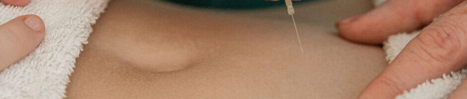 IVF Support Acupuncture